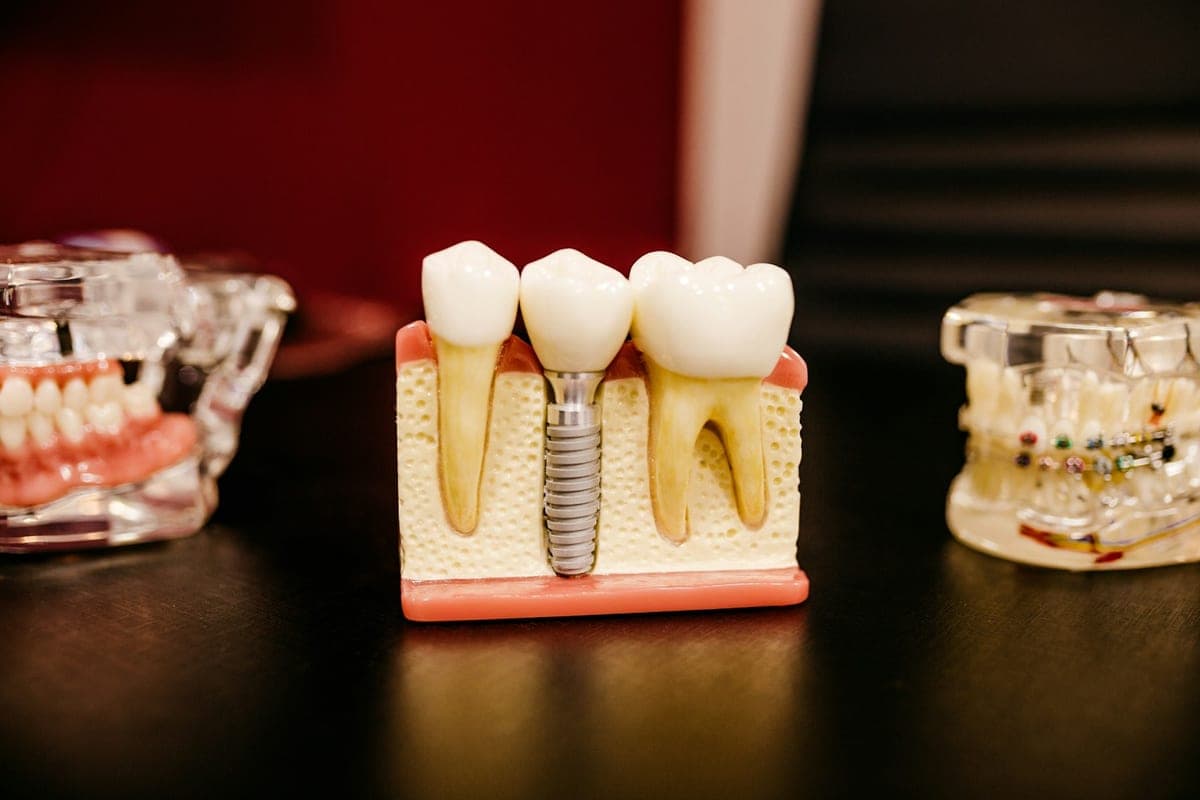 A dental implant model at Marloe Dental